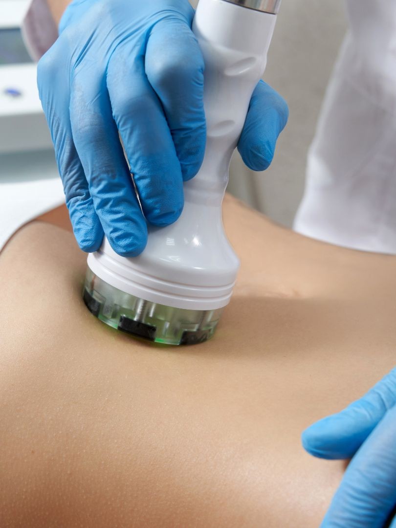 Close-up of a body contouring treatment in Albuquerque